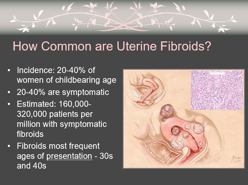 How Common Are Uterine Fibroids